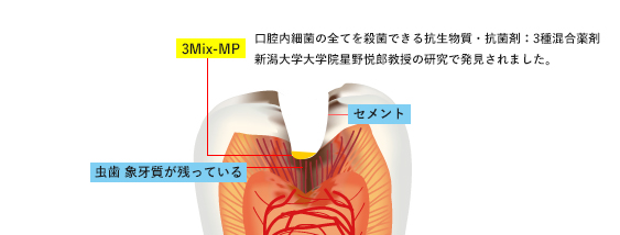 3Mix-MP法とは