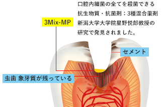 薬で治す無痛歯科治療