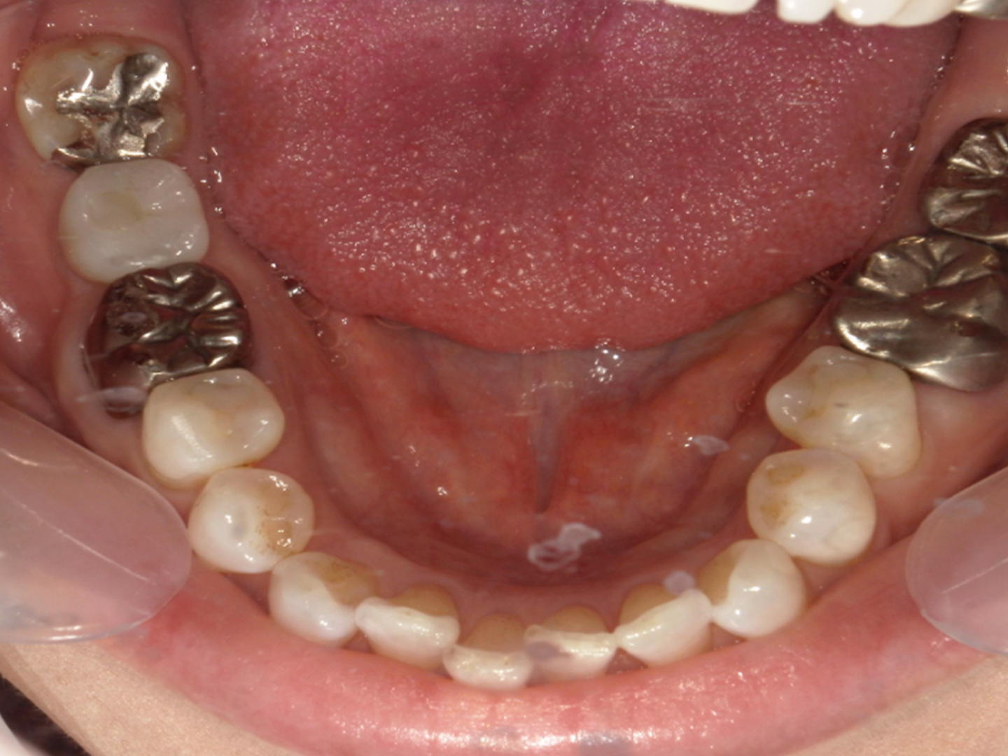 症例写真