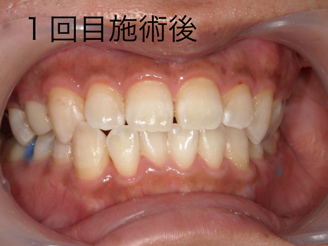 ホワイトニング症例治療後