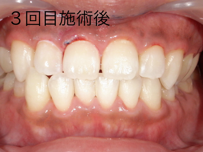 ホワイトニング症例治療後