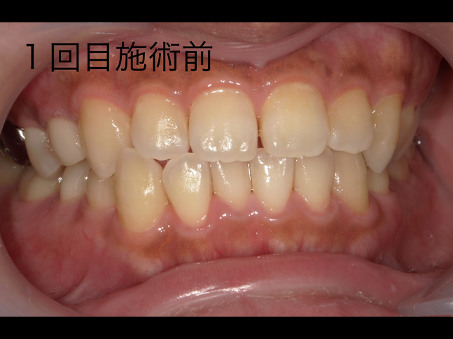 ホワイトニング症例治療前